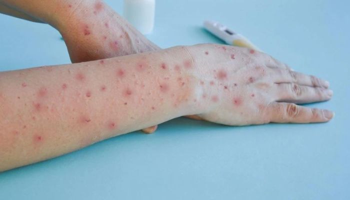 केरल में मिला Monkeypox का दूसरा केस ! स्वास्थ्य मंत्रालय ने जारी की एडवाइजरी